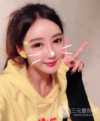 全臉自體脂肪填充手術(shù)日記分享，改良臉型年輕十歲