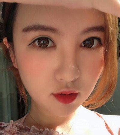 隆鼻整形手術(shù)個人經(jīng)歷分享,精致小翹鼻不是夢