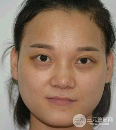切開雙眼皮術(shù)后改良雙眼不對(duì)稱,恢復(fù)果圖分享
