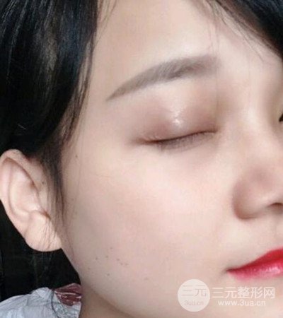 切開雙眼皮術(shù)后改良雙眼不對(duì)稱,恢復(fù)果圖分享