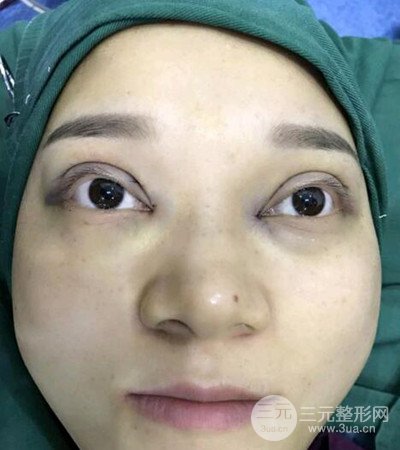 切開雙眼皮術(shù)后改良雙眼不對(duì)稱,恢復(fù)果圖分享