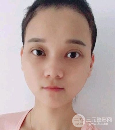 切開雙眼皮術(shù)后改良雙眼不對(duì)稱,恢復(fù)果圖分享