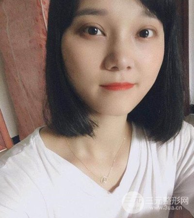 切開雙眼皮術(shù)后改良雙眼不對(duì)稱,恢復(fù)果圖分享