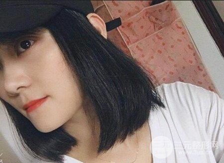 切開雙眼皮術(shù)后改良雙眼不對(duì)稱,恢復(fù)果圖分享