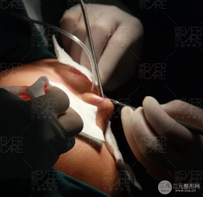 北京伊美爾徐軍假體隆鼻前后對比照片心情日記