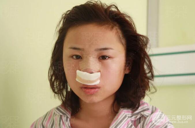 北京伊美爾徐軍假體隆鼻前后對比照片心情日記