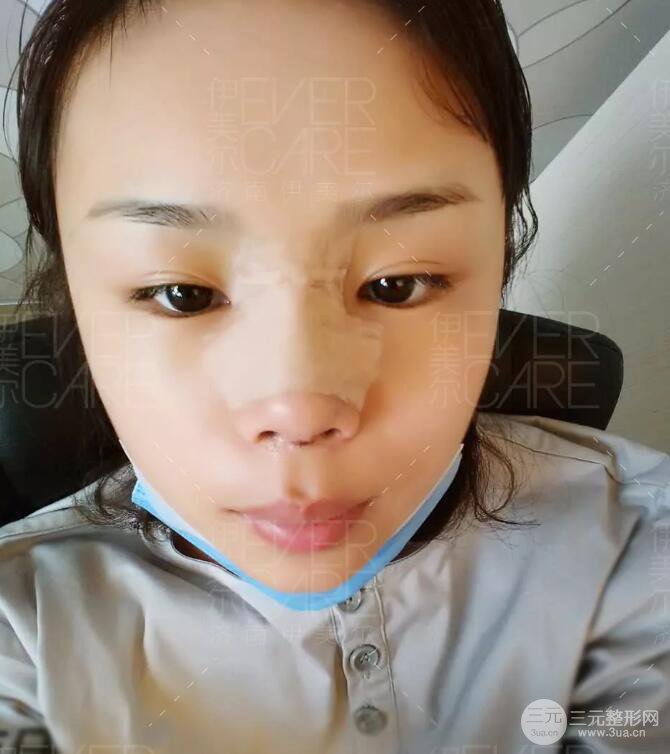 北京伊美爾徐軍假體隆鼻前后對比照片心情日記