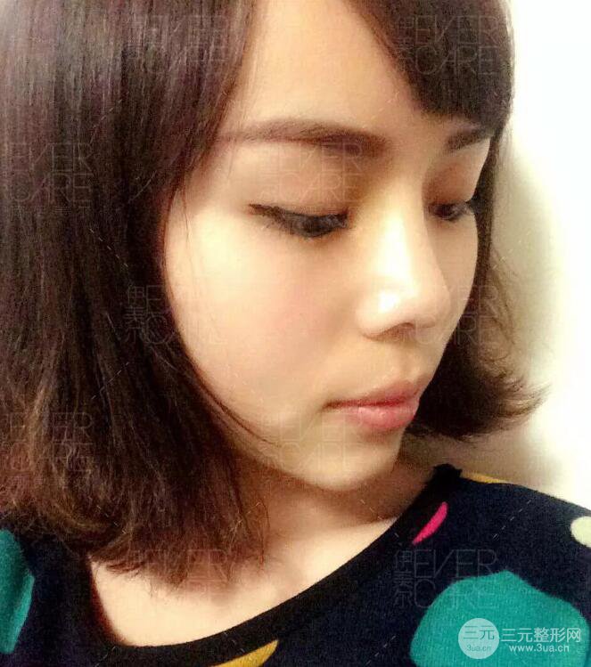 北京伊美爾徐軍假體隆鼻前后對比照片心情日記