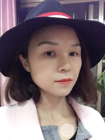 隆鼻整形手術(shù)真人案例恢復(fù)過(guò)程分享 附上果圖