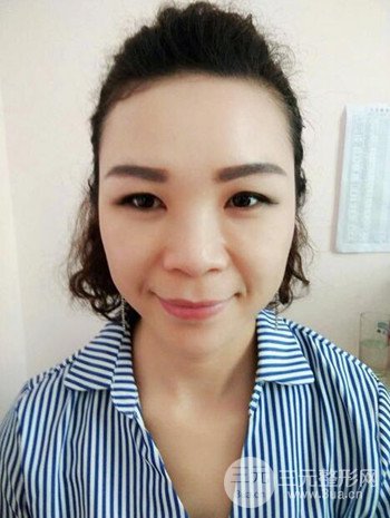 隆鼻整形手術(shù)真人案例恢復(fù)過(guò)程分享 附上果圖