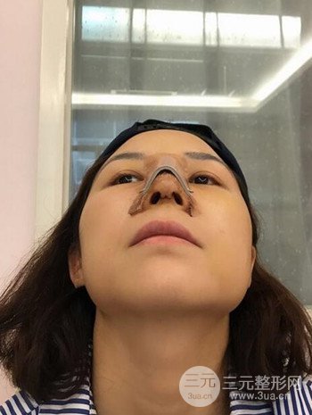 隆鼻整形手術(shù)真人案例恢復(fù)過(guò)程分享 附上果圖