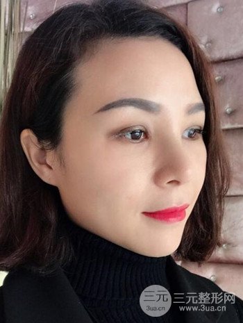 隆鼻整形手術(shù)真人案例恢復(fù)過(guò)程分享 附上果圖