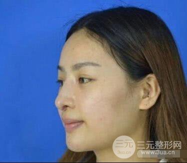 吉林銘醫(yī)李紅肋骨隆鼻整形前后對不圖果恢復(fù)心情小札