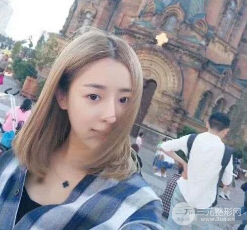 吉林銘醫(yī)李紅肋骨隆鼻整形前后對不圖果恢復(fù)心情小札