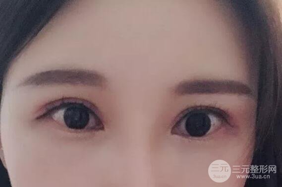 蘭大二院張選奮怎么樣?雙眼皮修復(fù)案例前后對(duì)比圖