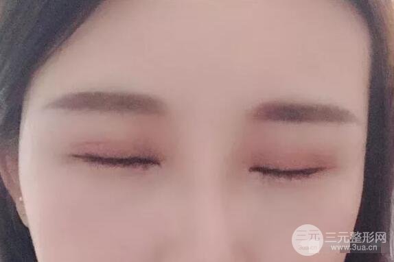 蘭大二院張選奮怎么樣?雙眼皮修復(fù)案例前后對(duì)比圖