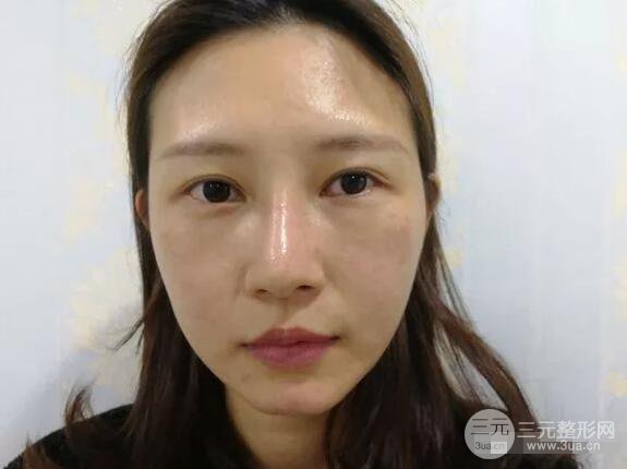 蘭大二院張選奮怎么樣?雙眼皮修復(fù)案例前后對(duì)比圖