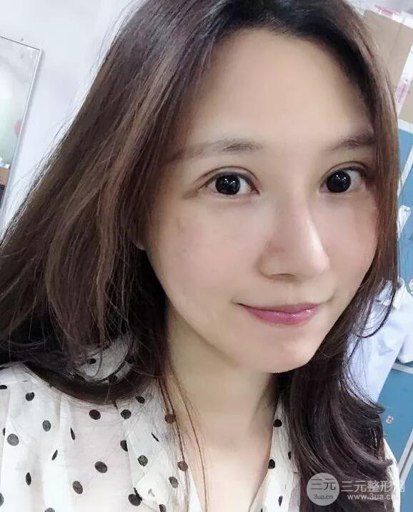 蘭大二院張選奮怎么樣?雙眼皮修復(fù)案例前后對(duì)比圖