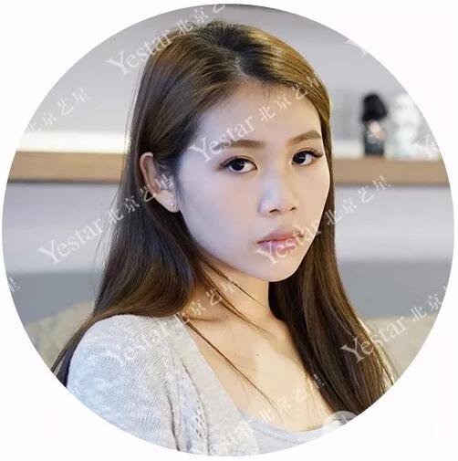 北京藝星仇侃敏耳軟骨隆鼻恢復過程|內(nèi)附前后對比圖