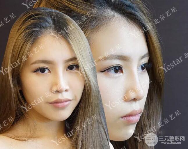 北京藝星仇侃敏耳軟骨隆鼻恢復過程|內(nèi)附前后對比圖