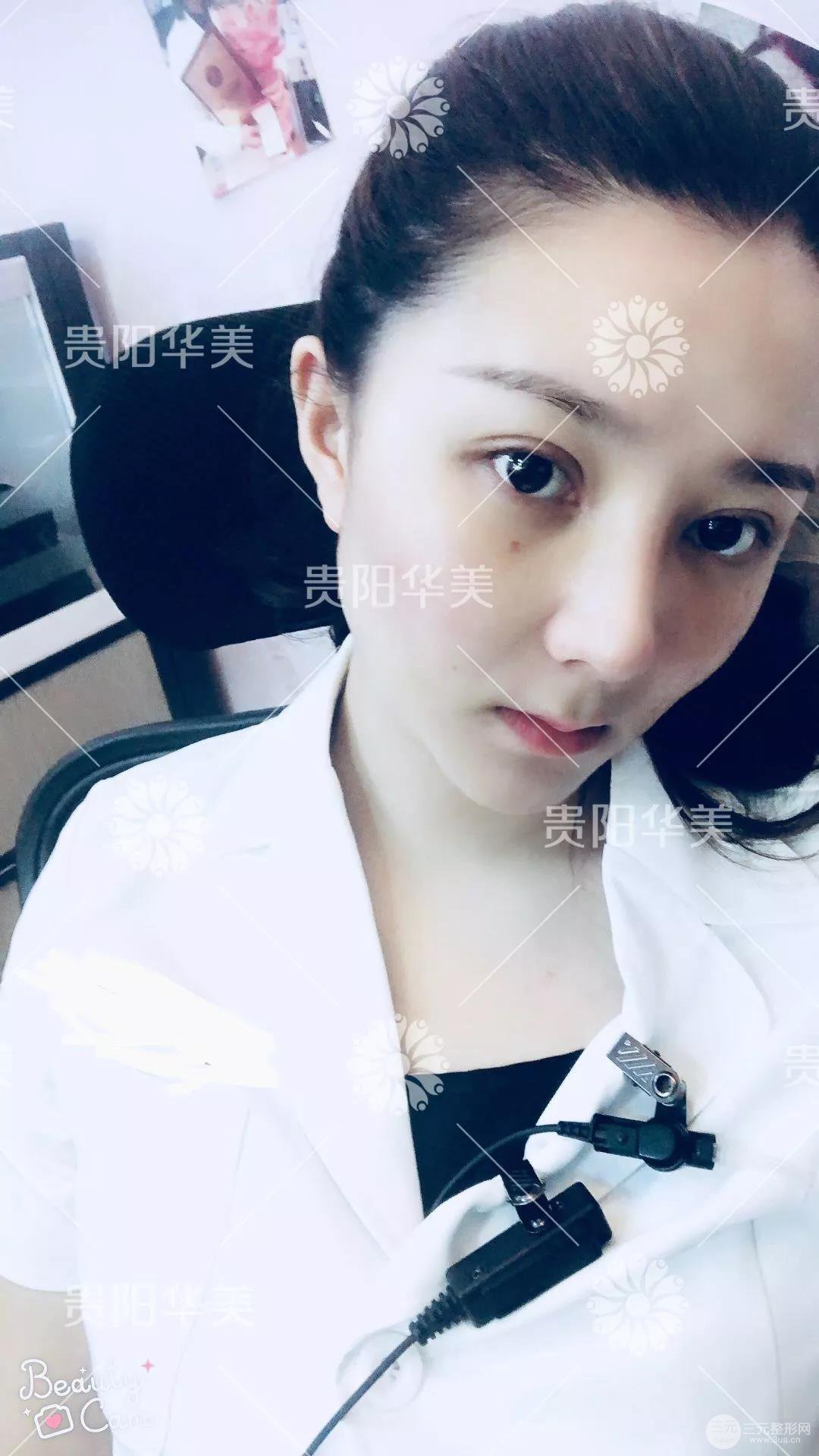 貴陽華美郭宗科全切雙眼皮+假體隆鼻案例前后對比圖 華美員工全臉整形實錄