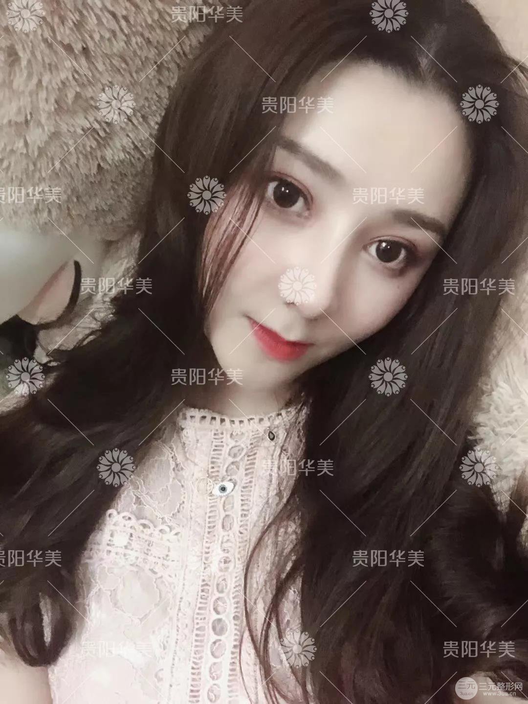 貴陽華美郭宗科全切雙眼皮+假體隆鼻案例前后對比圖 華美員工全臉整形實錄