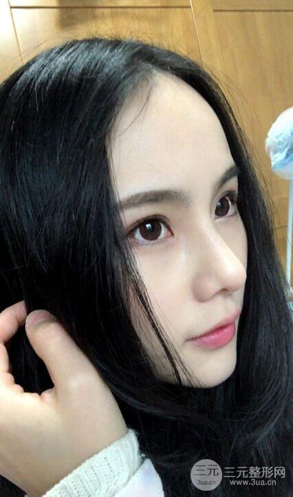 成都大華隆鼻怎么樣?真實案例前后對比圖記錄恢復(fù)過程