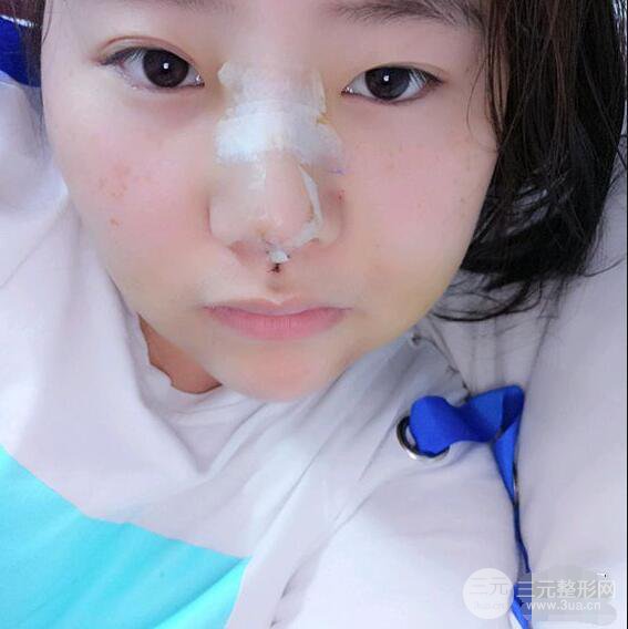 合肥壹加壹甘泉涌軟骨隆鼻前后對比圖|內附真人案例恢復前過程