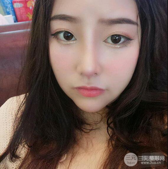 合肥壹加壹甘泉涌軟骨隆鼻前后對比圖|內附真人案例恢復前過程