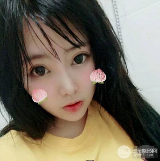 合肥壹加壹甘泉涌軟骨隆鼻前后對比圖|內附真人案例恢復前過程