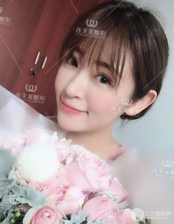 南京連天美整形周長(zhǎng)兵隆鼻整形真人案例前后對(duì)比圖|內(nèi)附恢復(fù)過(guò)程心情日扎