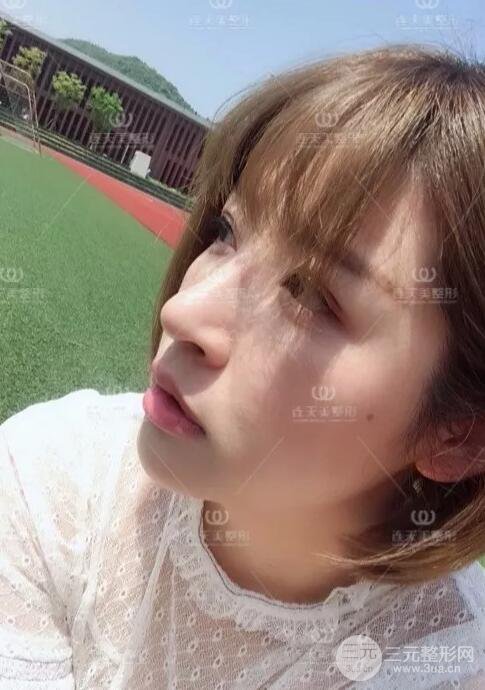 南京連天美整形周長(zhǎng)兵隆鼻整形真人案例前后對(duì)比圖|內(nèi)附恢復(fù)過(guò)程心情日扎