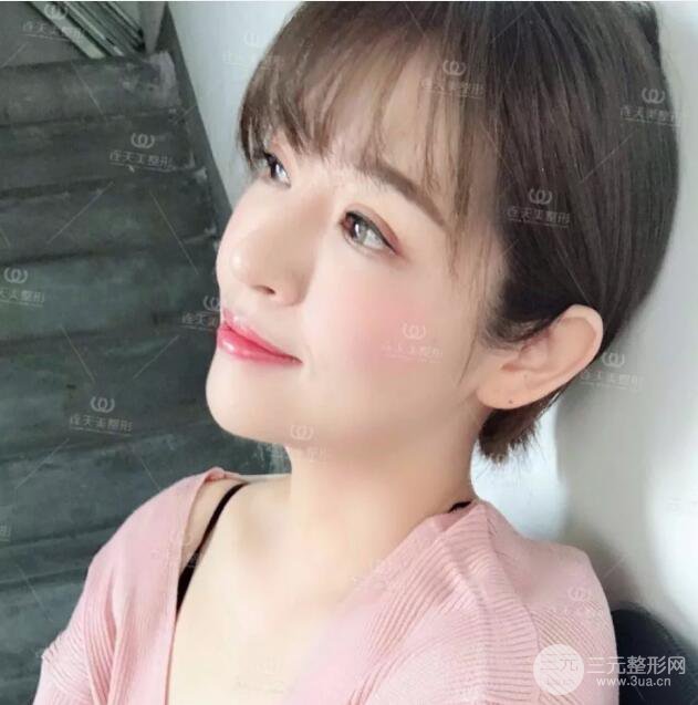 南京連天美整形周長(zhǎng)兵隆鼻整形真人案例前后對(duì)比圖|內(nèi)附恢復(fù)過(guò)程心情日扎