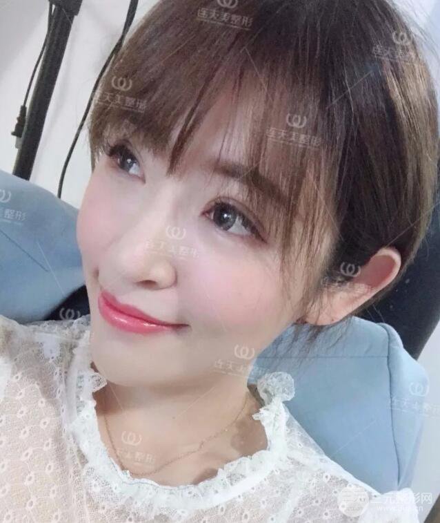 南京連天美整形周長(zhǎng)兵隆鼻整形真人案例前后對(duì)比圖|內(nèi)附恢復(fù)過(guò)程心情日扎