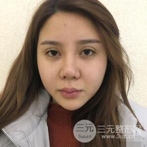 昆明吳氏嘉美李明硅膠隆鼻前后對(duì)比圖恢復(fù)心情小札