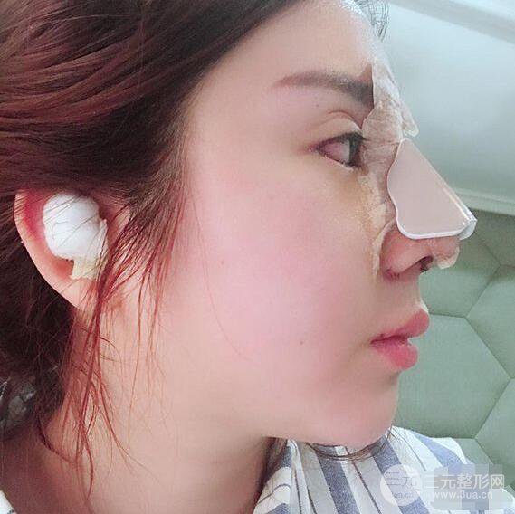 昆明吳氏嘉美李明硅膠隆鼻前后對(duì)比圖恢復(fù)心情小札