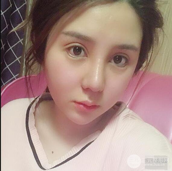 昆明吳氏嘉美李明硅膠隆鼻前后對(duì)比圖恢復(fù)心情小札