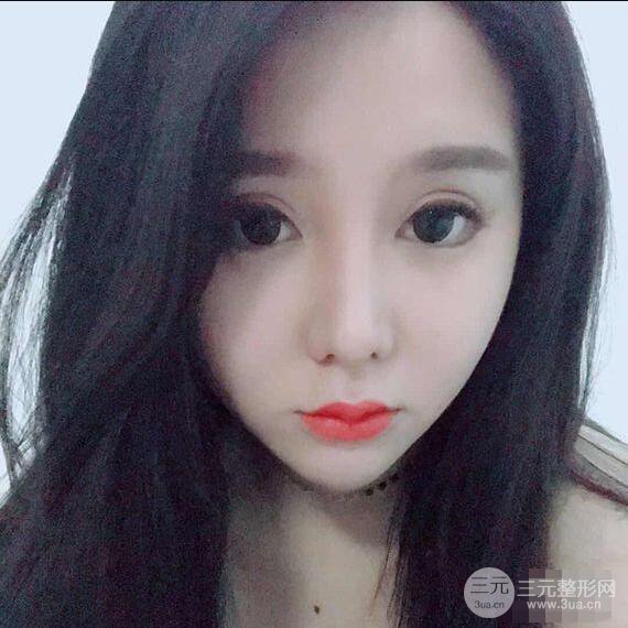 昆明吳氏嘉美李明硅膠隆鼻前后對(duì)比圖恢復(fù)心情小札
