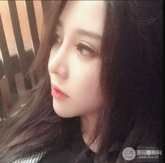 昆明吳氏嘉美李明硅膠隆鼻前后對(duì)比圖恢復(fù)心情小札