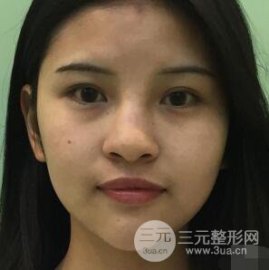 成都華西醫(yī)院整形美容科卿勇隆鼻整形前后對比圖恢復(fù)心情小札