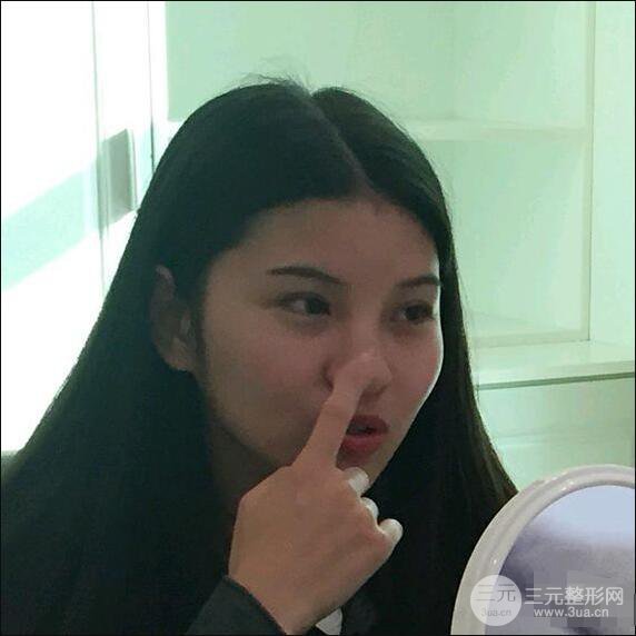 成都華西醫(yī)院整形美容科卿勇隆鼻整形前后對比圖恢復(fù)心情小札