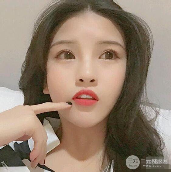 成都華西醫(yī)院整形美容科卿勇隆鼻整形前后對比圖恢復(fù)心情小札