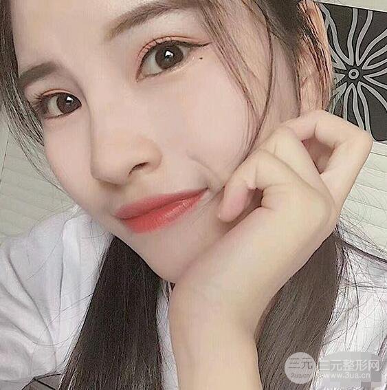 成都華西醫(yī)院整形美容科卿勇隆鼻整形前后對比圖恢復(fù)心情小札