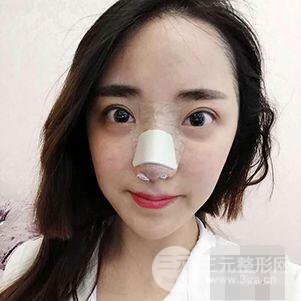 杭州格萊美張樹功假體隆鼻前后對比圖|內(nèi)附恢復(fù)心情變化哦