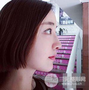杭州格萊美張樹功假體隆鼻前后對比圖|內(nèi)附恢復(fù)心情變化哦
