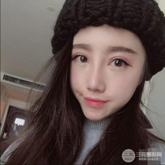 北京聯(lián)合麗格吳焱秋耳軟骨隆鼻前后對比圖|塌鼻子的救星