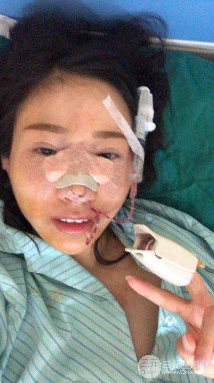 昆明華美美萊楊繼紅肋軟骨隆鼻前后對(duì)比圖恢復(fù)手札