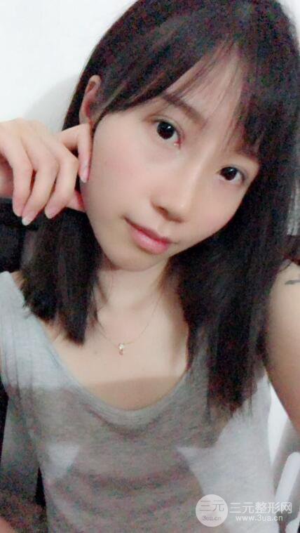 昆明華美美萊楊繼紅肋軟骨隆鼻前后對(duì)比圖恢復(fù)手札