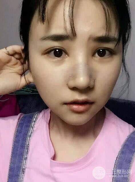 青醫(yī)附院美容科任紀(jì)禎塌鼻子隆鼻前后對比圖恢復(fù)心情小札