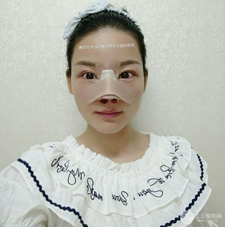 廈門修志夫隆鼻整形前后對比圖真人案例恢復(fù)小札